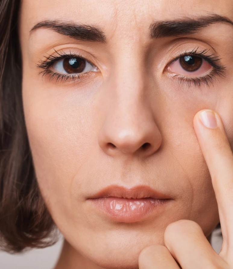 woman with a very red dry eye