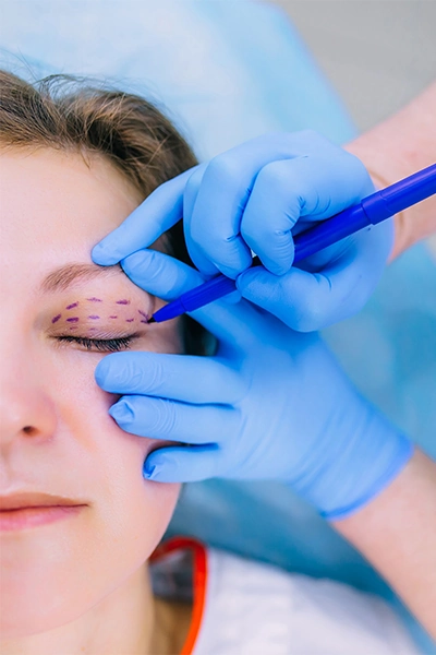 Blepharoplasty incision markings on upper eyelid