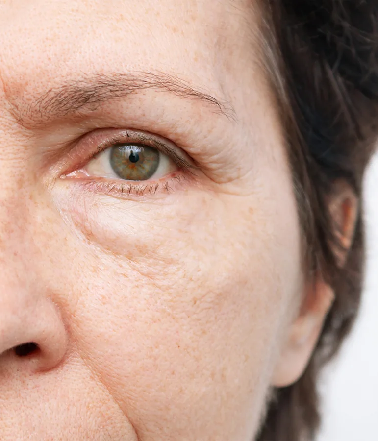 a woman with hooding eyelid and puffiness under eye